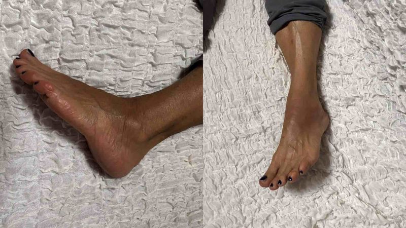 traumatic%20fracture%20of%20tarsal%20scaphoid%202.jpeg