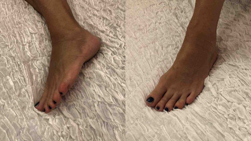 traumatic%20fracture%20of%20tarsal%20scaphoid%203.jpeg